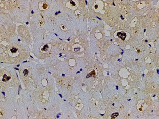LIMK1 / LIMK Antibody - 1:200 staining human heart tissue by IHC-P. The tissue was formaldehyde fixed and a heat mediated antigen retrieval step in citrate buffer was performed. The tissue was then blocked and incubated with the antibody for 1.5 hours at 22°C. An HRP conjugated goat anti-rabbit antibody was used as the secondary.