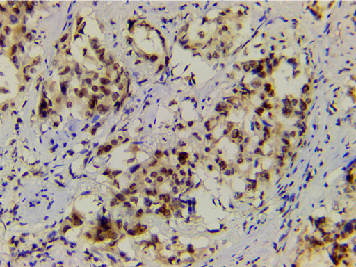 LIMK1 / LIMK Antibody - 1:200 staining human lung carcinoma tissue by IHC-P. The tissue was formaldehyde fixed and a heat mediated antigen retrieval step in citrate buffer was performed. The tissue was then blocked and incubated with the antibody for 1.5 hours at 22°C. An HRP conjugated goat anti-rabbit antibody was used as the secondary.