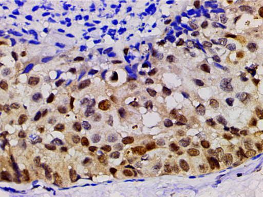 LIMK1 / LIMK Antibody - 1:200 staining human gastric tissue by IHC-P. The tissue was formaldehyde fixed and a heat mediated antigen retrieval step in citrate buffer was performed. The tissue was then blocked and incubated with the antibody for 1.5 hours at 22°C. An HRP conjugated goat anti-rabbit antibody was used as the secondary.