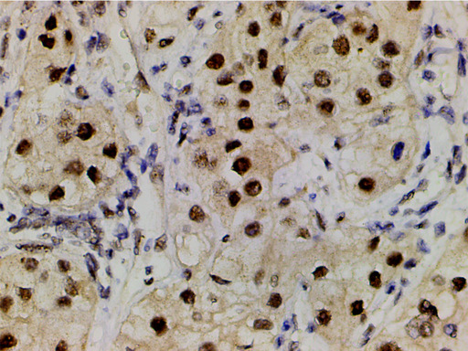 LIMK1 / LIMK Antibody - 1:200 staining human renal clear cells carcinoma tissue by IHC-P. The tissue was formaldehyde fixed and a heat mediated antigen retrieval step in citrate buffer was performed. The tissue was then blocked and incubated with the antibody for 1.5 hours at 22°C. An HRP conjugated goat anti-rabbit antibody was used as the secondary.