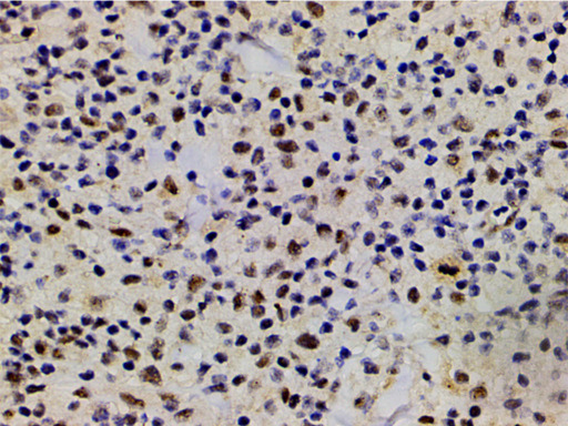 LIMK1 / LIMK Antibody - 1:200 staining human lymphoma tissue by IHC-P. The tissue was formaldehyde fixed and a heat mediated antigen retrieval step in citrate buffer was performed. The tissue was then blocked and incubated with the antibody for 1.5 hours at 22°C. An HRP conjugated goat anti-rabbit antibody was used as the secondary.