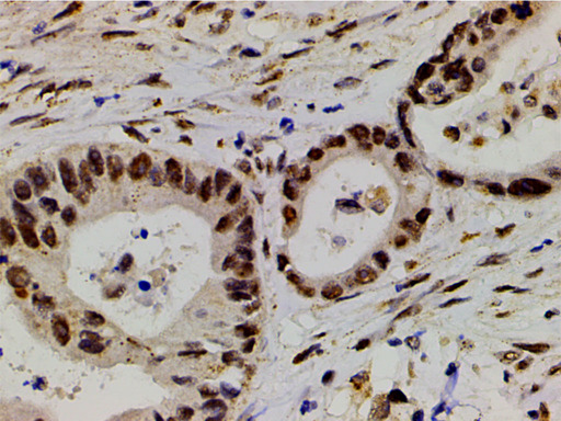 LIMK1 / LIMK Antibody - 1:200 staining human colon carcinoma tissue by IHC-P. The tissue was formaldehyde fixed and a heat mediated antigen retrieval step in citrate buffer was performed. The tissue was then blocked and incubated with the antibody for 1.5 hours at 22°C. An HRP conjugated goat anti-rabbit antibody was used as the secondary.