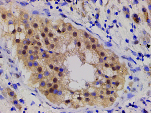 LIMK1 / LIMK Antibody - 1:200 staining human seminoma tissue by IHC-P. The tissue was formaldehyde fixed and a heat mediated antigen retrieval step in citrate buffer was performed. The tissue was then blocked and incubated with the antibody for 1.5 hours at 22°C. An HRP conjugated goat anti-rabbit antibody was used as the secondary.