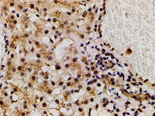 LIMK1 / LIMK Antibody - 1:200 staining human vascular carcinoma tissue by IHC-P. The tissue was formaldehyde fixed and a heat mediated antigen retrieval step in citrate buffer was performed.The tissue was then blocked and incubated with the antibody for 1.5 hours at 22°C. An HRP conjugated goat anti-rabbit antibody was used as the secondary.