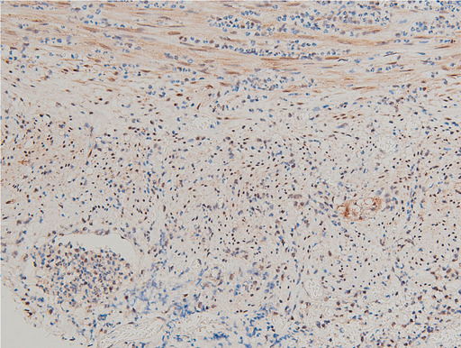 LIMK1 / LIMK Antibody - 1:100 staining rat appendix tissue by IHC-P. The tissue was formaldehyde fixed and a heat mediated antigen retrieval step in citrate buffer was performed. The tissue was then blocked and incubated with the antibody for 1.5 hours at 22°C. An HRP conjugated goat anti-rabbit antibody was used as the secondary.
