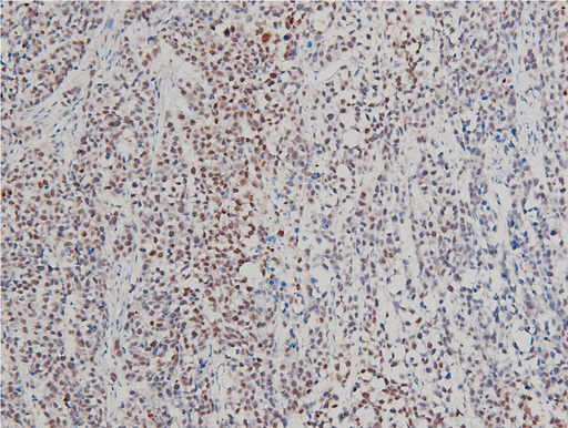 LIMK1 / LIMK Antibody - 1:100 staining rat tumor tissue by IHC-P. The tissue was formaldehyde fixed and a heat mediated antigen retrieval step in citrate buffer was performed. The tissue was then blocked and incubated with the antibody for 1.5 hours at 22°C. An HRP conjugated goat anti-rabbit antibody was used as the secondary.