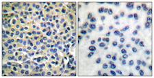 LIMK1 + LIMK2 Antibody - Immunohistochemistry analysis of paraffin-embedded human breast carcinoma tissue, using LIMK1/2 Antibody. The picture on the right is blocked with the synthesized peptide.