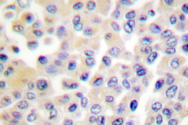LIMK1 + LIMK2 Antibody - IHC of LIMK1/2 (D402) pAb in paraffin-embedded human breast carcinoma tissue.