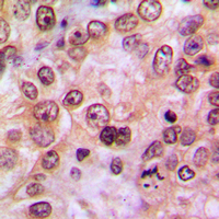 LIMK1 + LIMK2 Antibody - Immunohistochemical analysis of LIMK1/2 (pT508/505) staining in human breast cancer formalin fixed paraffin embedded tissue section. The section was pre-treated using heat mediated antigen retrieval with sodium citrate buffer (pH 6.0). The section was then incubated with the antibody at room temperature and detected using an HRP conjugated compact polymer system. DAB was used as the chromogen. The section was then counterstained with hematoxylin and mounted with DPX.