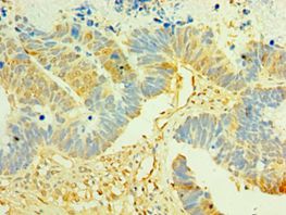 LIMK2 Antibody - Immunohistochemistry of paraffin-embedded human ovarian cancer using antibody at 1:100 dilution.