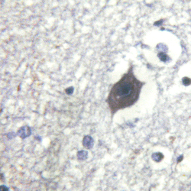 LIMK2 Antibody - 1/100 staining human brain tissue by IHC-P. The sample was formaldehyde fixed and a heat mediated antigen retrieval step in citrate buffer was performed. The sample was then blocked and incubated with the antibody for 1.5 hours at 22°C. An HRP conjugated goat anti-rabbit antibody was used as the secondary antibody.