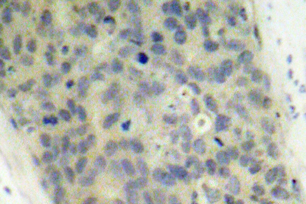 LIMK2 Antibody - IHC of p-LIMK2 (T505) pAb in paraffin-embedded human breast carcinoma tissue.