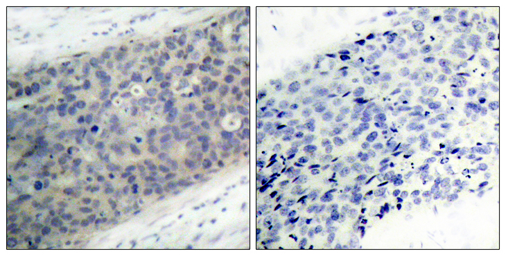 LIMK2 Antibody - Immunohistochemistry analysis of paraffin-embedded human breast carcinoma, using LIMK2 (Phospho-Thr505) Antibody. The picture on the right is blocked with the phospho peptide.