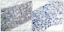 LIMK2 Antibody - Immunohistochemistry analysis of paraffin-embedded human breast carcinoma, using LIMK2 (Phospho-Thr505) Antibody. The picture on the right is blocked with the phospho peptide.