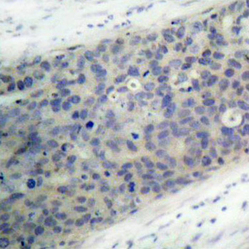 LIMK2 Antibody - Immunohistochemical analysis of paraffin-embedded human breast carcinoma tissue.