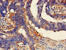 LIMPII / SCARB2 Antibody - Immunohistochemistry of paraffin-embedded human colon cancer using SCARB2 Antibody at dilution of 1:100