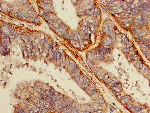 LIMPII / SCARB2 Antibody - Immunohistochemistry of paraffin-embedded human endometrial cancer using SCARB2 Antibody at dilution of 1:100