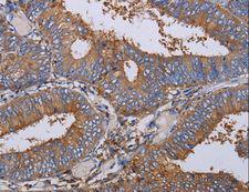 LIMS1 / PINCH Antibody - Immunohistochemistry of paraffin-embedded Human colon cancer using LIMS1 Polyclonal Antibody at dilution of 1:40.