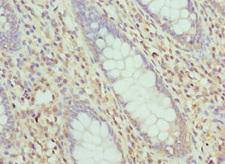 LIMS1 / PINCH Antibody - Immunohistochemistry of paraffin-embedded human colon cancer at dilution 1:100