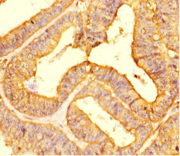 LIMS3 Antibody - Immunohistochemistry of paraffin-embedded human endometrial cancer using LIMS3 Antibody at dilution of 1:100