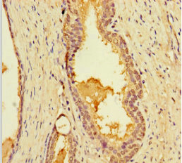 LIMS3 Antibody - Immunohistochemistry of paraffin-embedded human prostate cancer using LIMS3 Antibody at dilution of 1:100
