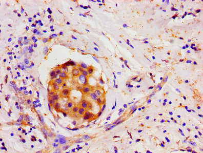 LIN28A / LIN28 Antibody - Immunohistochemistry image of paraffin-embedded human breast cancer at a dilution of 1:100