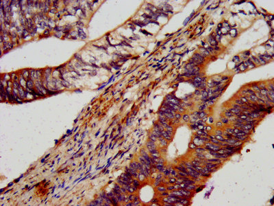 LIN41 / TRIM71 Antibody - Immunohistochemistry image at a dilution of 1:600 and staining in paraffin-embedded human colon cancer performed on a Leica BondTM system. After dewaxing and hydration, antigen retrieval was mediated by high pressure in a citrate buffer (pH 6.0) . Section was blocked with 10% normal goat serum 30min at RT. Then primary antibody (1% BSA) was incubated at 4 °C overnight. The primary is detected by a biotinylated secondary antibody and visualized using an HRP conjugated SP system.