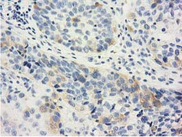 LIN7B Antibody - IHC of paraffin-embedded Carcinoma of Human bladder tissue using anti-LIN7B mouse monoclonal antibody. (Dilution 1:50).