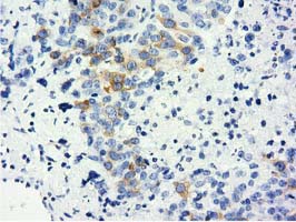 LIN7B Antibody - IHC of paraffin-embedded Adenocarcinoma of Human ovary tissue using anti-LIN7B mouse monoclonal antibody. (Dilution 1:50).