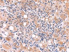LIPA / Lysosomal Acid Lipase Antibody - Immunohistochemistry of paraffin-embedded Human liver cancer tissue  using LIPA Polyclonal Antibody at dilution of 1:50(×200)
