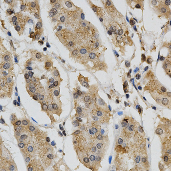 LIPC / Hepatic Lipase Antibody - Immunohistochemistry of paraffin-embedded human colon cancer tissue.