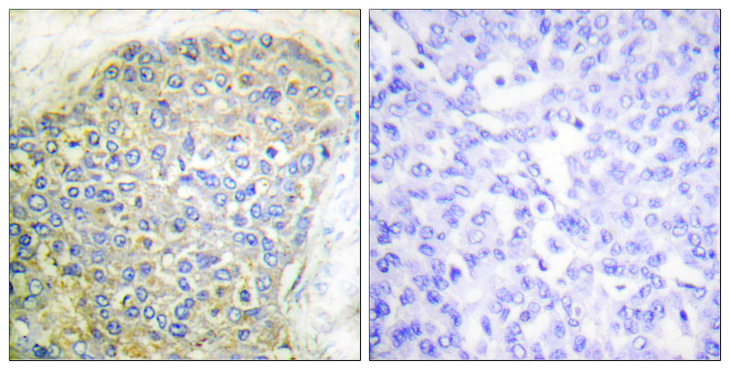 LIPE / HSL Antibody - Immunohistochemistry analysis of paraffin-embedded human breast carcinoma tissue, using HSL Antibody. The picture on the right is blocked with the synthesized peptide.