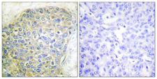 LIPE / HSL Antibody - Immunohistochemistry analysis of paraffin-embedded human breast carcinoma tissue, using HSL Antibody. The picture on the right is blocked with the synthesized peptide.