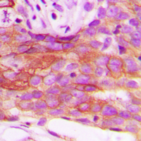 LIPE / HSL Antibody - Immunohistochemical analysis of HSL staining in human breast cancer formalin fixed paraffin embedded tissue section. The section was pre-treated using heat mediated antigen retrieval with sodium citrate buffer (pH 6.0). The section was then incubated with the antibody at room temperature and detected using an HRP conjugated compact polymer system. DAB was used as the chromogen. The section was then counterstained with hematoxylin and mounted with DPX.