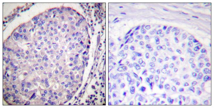 LIPE / HSL Antibody - Peptide - + Immunohistochemistry analysis of paraffin-embedded human breast carcinoma tissue using HSL (Ab-554) antibody.