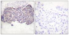 LIPE / HSL Antibody - Immunohistochemistry analysis of paraffin-embedded human breast carcinoma, using HSL (Phospho-Ser552) Antibody. The picture on the right is blocked with the phospho peptide.