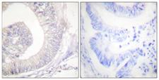 LIPE / HSL Antibody - Immunohistochemistry analysis of paraffin-embedded human colon carcinoma, using HSL (Phospho-Ser855/554) Antibody. The picture on the right is blocked with the phospho peptide.