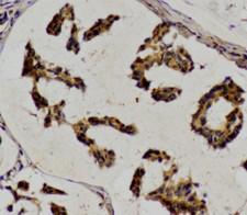 LIPE / HSL Antibody - IHC of HSL pAb in paraffin-embedded human breast carcinoma tissue.