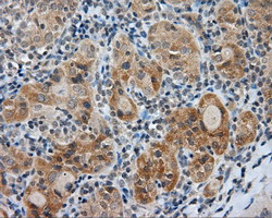 LIPG / Endothelial Lipase Antibody - IHC of paraffin-embedded Carcinoma of thyroid tissue using anti-LIPG mouse monoclonal antibody. (Dilution 1:50).