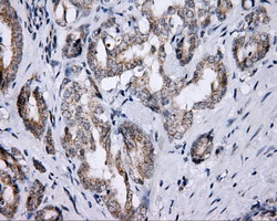 LIPG / Endothelial Lipase Antibody - IHC of paraffin-embedded Carcinoma of prostate tissue using anti-LIPG mouse monoclonal antibody. (Dilution 1:50).