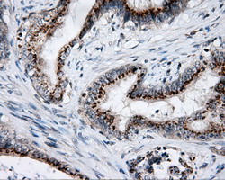 LIPG / Endothelial Lipase Antibody - IHC of paraffin-embedded Adenocarcinoma of colon tissue using anti-LIPG mouse monoclonal antibody. (Dilution 1:50).