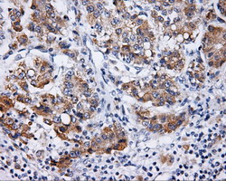 LIPG / Endothelial Lipase Antibody - IHC of paraffin-embedded Carcinoma of liver tissue using anti-LIPG mouse monoclonal antibody. (Dilution 1:50).