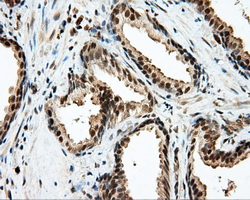 LIPG / Endothelial Lipase Antibody - Immunohistochemical staining of paraffin-embedded Carcinoma of prostate tissue using anti-LIPG mouse monoclonal antibody. (Dilution 1:50).
