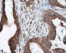LIPG / Endothelial Lipase Antibody - Immunohistochemical staining of paraffin-embedded Adenocarcinoma of colon tissue using anti-LIPG mouse monoclonal antibody. (Dilution 1:50).