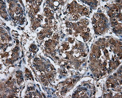 LIPG / Endothelial Lipase Antibody - Immunohistochemical staining of paraffin-embedded Carcinoma of liver tissue using anti-LIPG mouse monoclonal antibody. (Dilution 1:50).