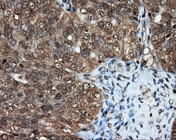 LIPG / Endothelial Lipase Antibody - Immunohistochemical staining of paraffin-embedded Adenocarcinoma of ovary tissue using anti-LIPG mouse monoclonal antibody. (Dilution 1:50).