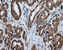 LIPG / Endothelial Lipase Antibody - Immunohistochemical staining of paraffin-embedded Carcinoma of prostate tissue using anti-LIPG mouse monoclonal antibody. (Dilution 1:50).