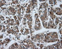 LIPG / Endothelial Lipase Antibody - Immunohistochemical staining of paraffin-embedded Carcinoma of liver tissue using anti-LIPG mouse monoclonal antibody. (Dilution 1:50).