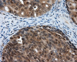 LIPG / Endothelial Lipase Antibody - IHC of paraffin-embedded Adenocarcinoma of ovary tissue using anti-LIPG mouse monoclonal antibody. (Dilution 1:50).