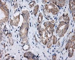 LIPG / Endothelial Lipase Antibody - IHC of paraffin-embedded Carcinoma of prostate tissue using anti-LIPG mouse monoclonal antibody. (Dilution 1:50).